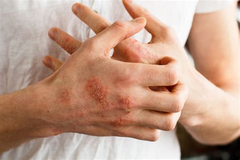 Atopic Dermatitis: Causes, Symptoms & Treatment Options - Academic Alliance In Dermatology