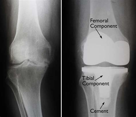 Knee Replacement - Surgery, Recovery Time, Complications