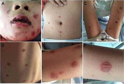 Frontiers | Case Report: Clinical and Immunological Features of a Chinese Cohort With Mycoplasma ...