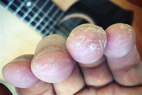 Guitarist Calluses: Resilience In The Hands - Stay Tuned