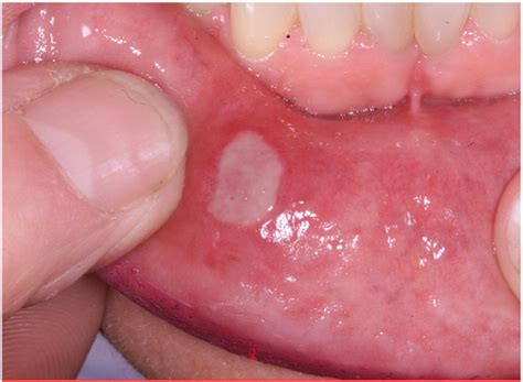 Recurrent aphthous stomatitis - Clinics in Dermatology