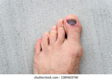 Nail Hematoma Take Care Your Feet Stock Photo 1389603740 | Shutterstock