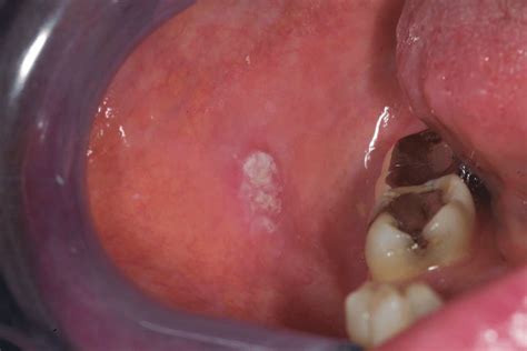 Right buccal mucosa squamous cell carcinoma (case 3). | Download Scientific Diagram