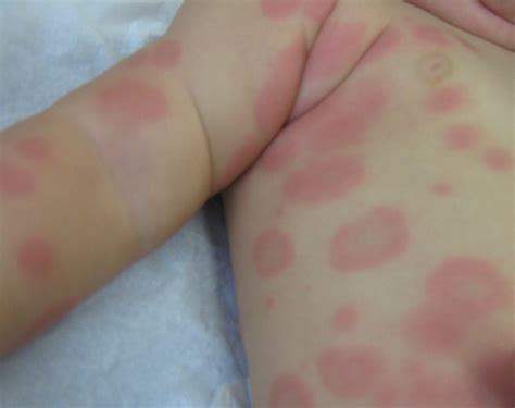 Erythema Multiforme Target Lesions