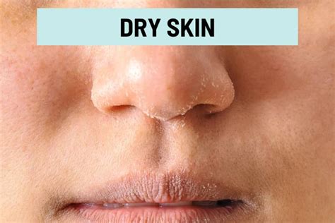 Dry and Peeling Skin Around Nose: 13 Causes & How to Treat it