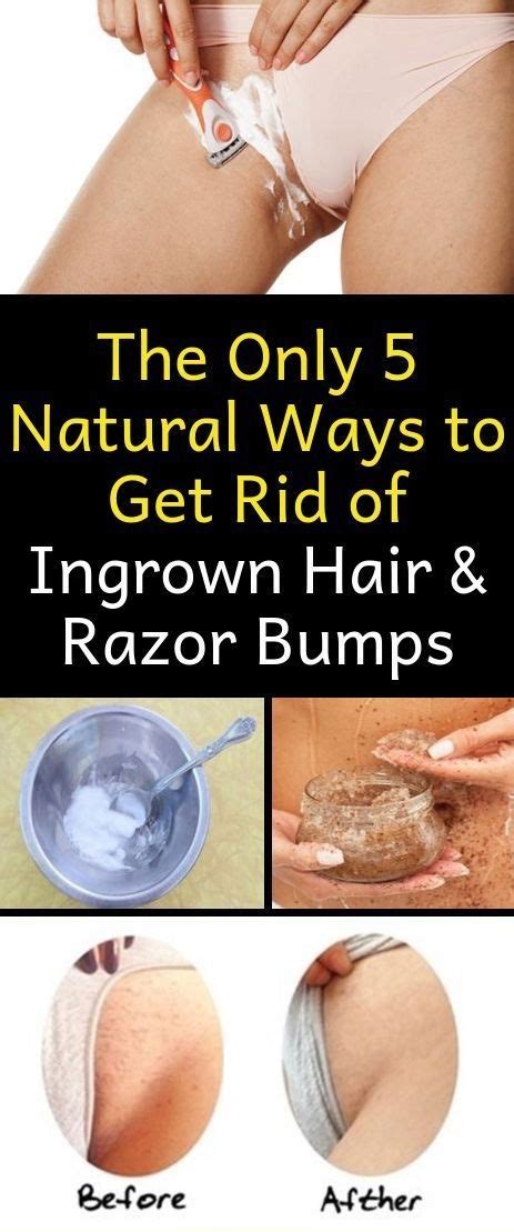 How to Get Rid of Razor Bumps on Bikini Area Naturally - Alorabarbie