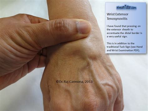 Wrist Extensor Tenosynovitis · RheumTutor