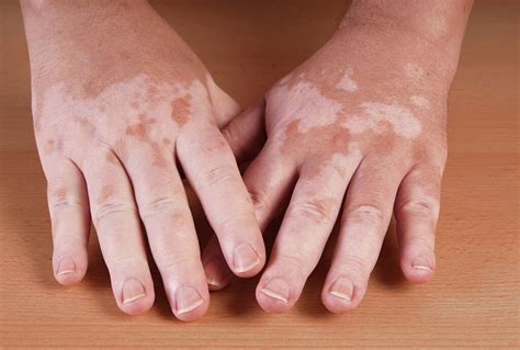 Leprosy: 10 Symptoms of Leprosy