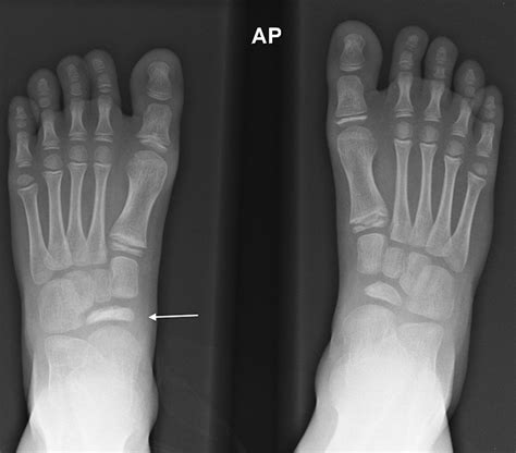 Chapter 20 – The Pediatric Foot | Musculoskeletal Key