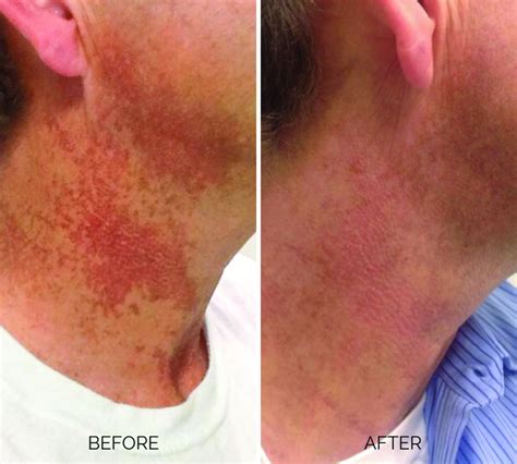 Treating poikiloderma | MDedge Dermatology