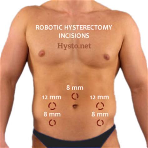 Laparoscopic Hysterectomy: Total Laparoscopic, Robotic, Vaginally-Assisted Laparoscopic Hysterectomy