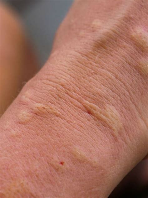 Hives (Urticaria) Functional Medicine Melbourne | Effective Treatment