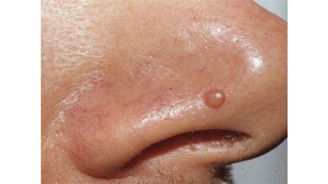 Fibrous Papule of the nose is a common skin condition. Learn about causes, symptoms ...