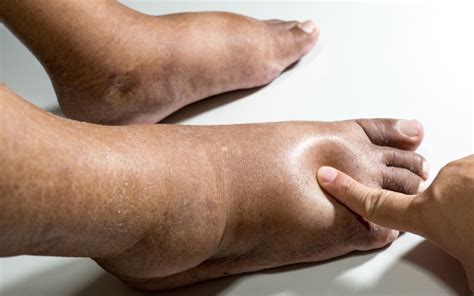 Why Are My Feet Swollen – Causes, Treatments, and Prevention - Massage and Spa Blog