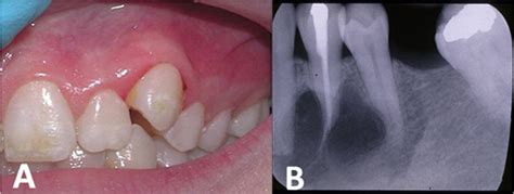 Towards better understanding of giant cell granulomas of the oral cavity | Journal of Clinical ...