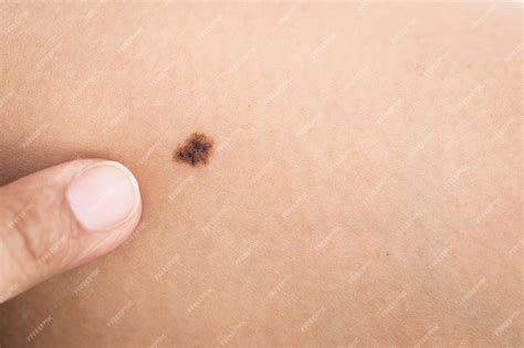 Shapes of Birthmarks: Nature's Unique Imprint - Itechment