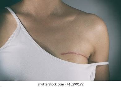 Breast Cancer Surgery Scars By Partial Stock Photo 413299192 | Shutterstock