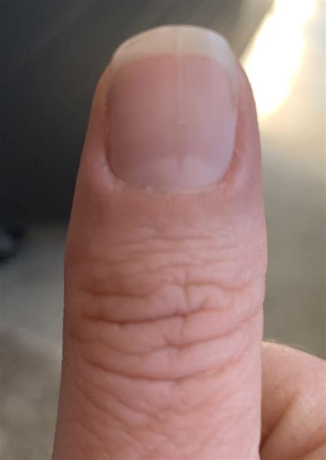 My thumb nail mysteriously grew a split in the middle that coincides with the wrinkles in my ...