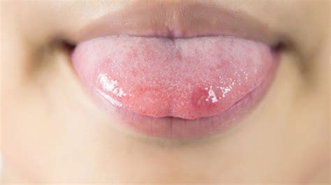 Can Candida Cause Lip Swelling | Sitelip.org