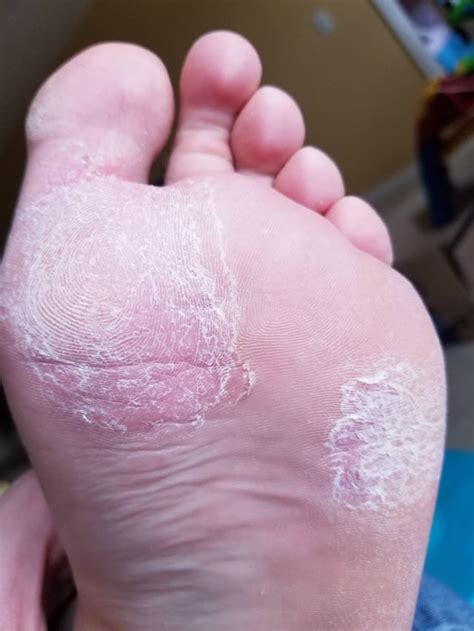 My foot's been like this for months... : r/peeling