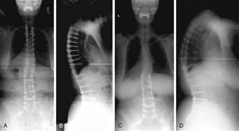 L1-S1 Fusion: When to Extend to T12 and Pelvis and When to Include L5-S1 Anterior Grafting ...