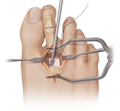 Plantar Plate Repair | Foot biomechanics, Repair, Plates