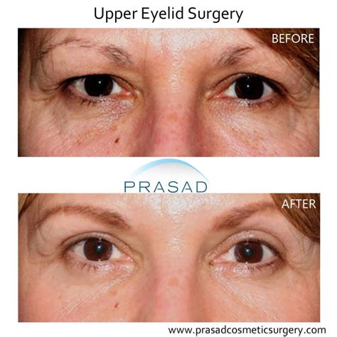 How Hooded Eye Surgery Scars are Minimized | Dr. Prasad Blog