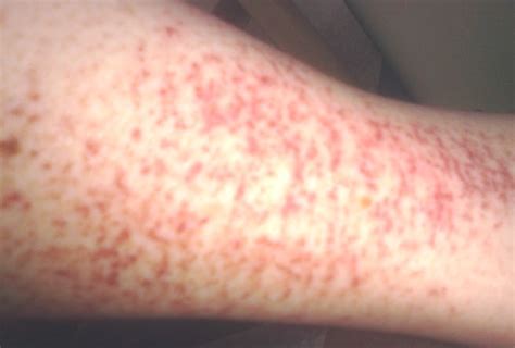 Pinpoint red dots on skin not itchy - moliintra