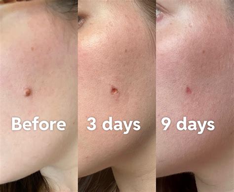 [Before & After] Mole removal edition! : r/SkincareAddiction