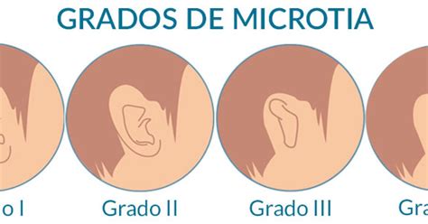 ¿Sabes que es la Microtia Atresia Bilateral?