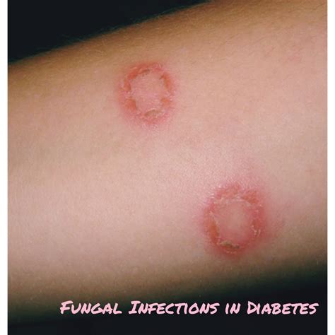 Bacterial Fungal Skin Rash