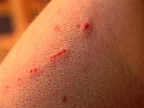 What Are the Signs and Symptoms of Cat Scratch Disease? - StoryMD