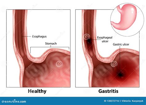 Gastritis And Esophageal Ulcer Vector Illustration | CartoonDealer.com ...