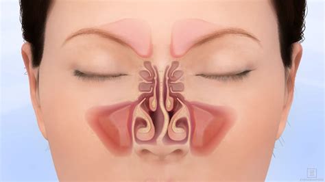 Deviated Nasal Septum | ENT Associates of San Diego