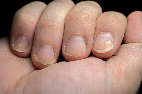 What Causes Black Lines In Fingernails Design Talk Vr - vrogue.co