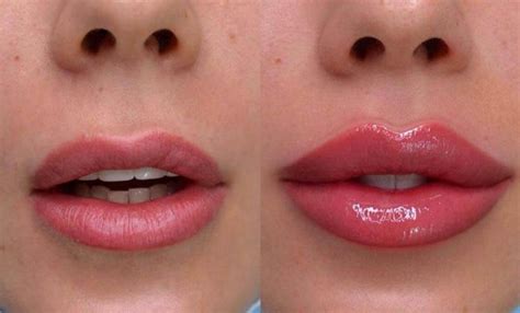 Russian Lip Filler Before & After | Skinly Aesthetics