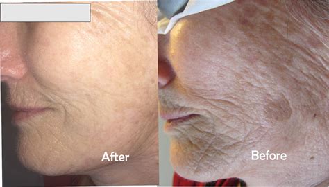 Age Spots On Face Removal