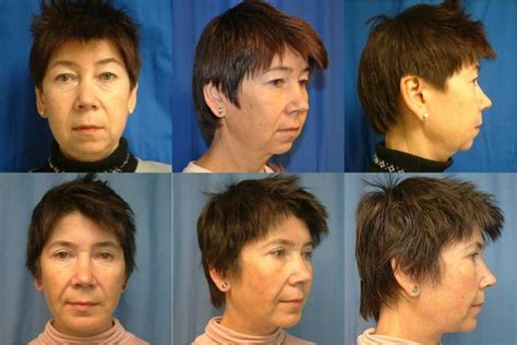 Facelift in Seattle by Top Plastic Surgeon Dr. Brian Windle – DR. BRIAN ...