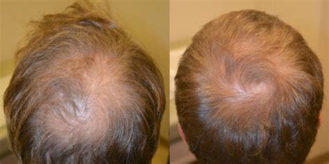 Propecia before and after photos - Dr Rogers - New Orleans