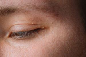 Eyelid Lesions Nashua | Eyelid Cancer Manchester | Medical Eye Center