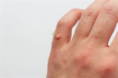 Warts 101: What you need to know about warts and wart removal ...