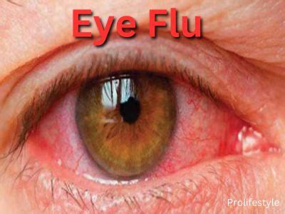 Red eye flu : Symptoms, cause, cure and FAQs ‣ Prolifestyle