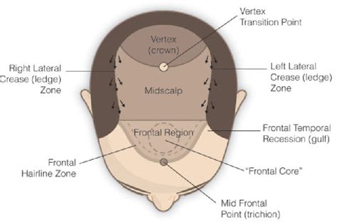 Figure 4 from Hairline design in hair replacement surgery. | Semantic Scholar