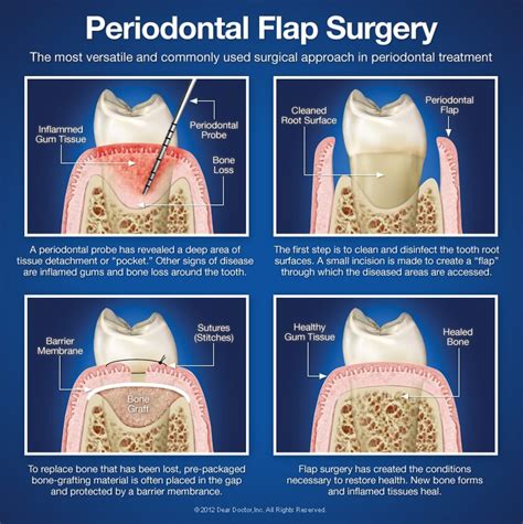 Periodontal Flap Surgery | Green Park Dental Hospital