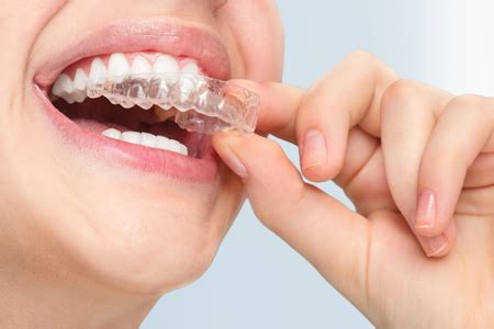 How to Care for Your Teeth During Invisalign Orthodontics Treatment ...