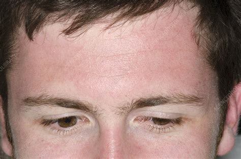 Mild sunburn on the face - Stock Image - C016/8253 - Science Photo Library