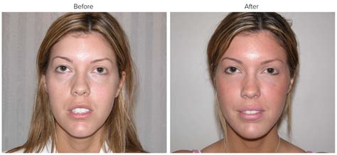 Facial Fat Grafting | Cosmetic Surgeon Ontario