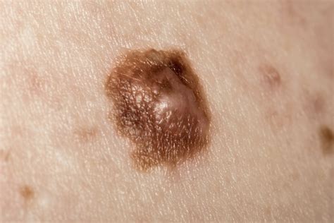 What Does It Mean If A Mole Goes Crusty? Understanding Skin Changes