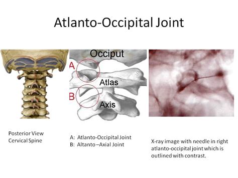 Headaches Arising from Atlanto Occipital Joint | CSC