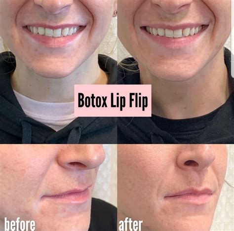 Lip Flip Before And After Photos